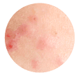 Impurezas